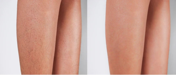 Genix laser hair treatment