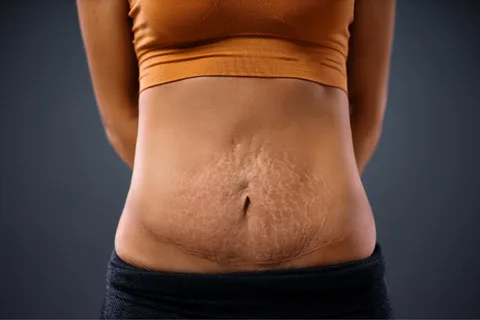 Genix Aesthetica || Service of Tattoo Removal  in Bhubaneswar || Pregnancy Stretch Marks